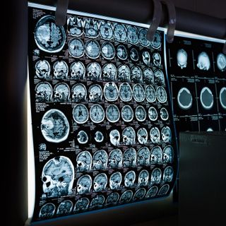 L'intelligenza artificiale, un aiuto in più per la diagnosi e il monitoraggio del Parkinson