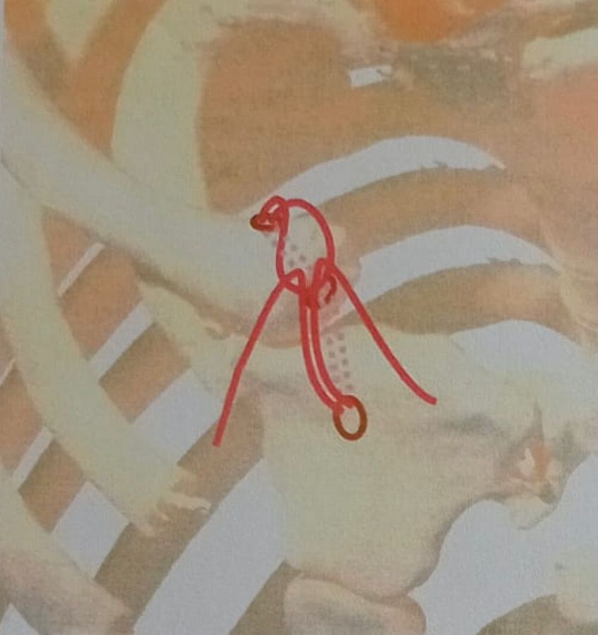 Intervento alle Molinette: torna a muovere il braccio grazie ad una clavicola personalizzata in 3D, è il secondo caso al mondo Intervento alle Molinette: torna a muovere il braccio grazie ad una clavicola personalizzata in 3D, è il secondo caso al mondo