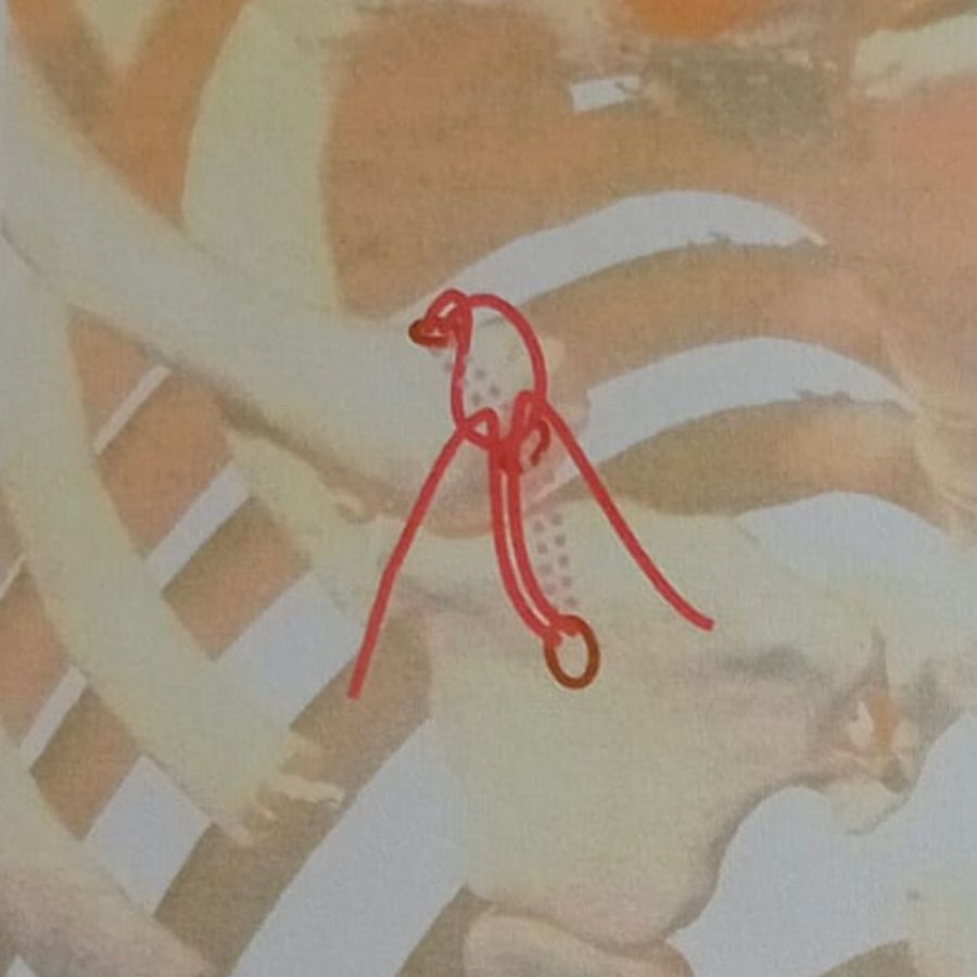 Intervento alle Molinette: torna a muovere il braccio  grazie ad una clavicola personalizzata in 3D, è il secondo caso al mondo