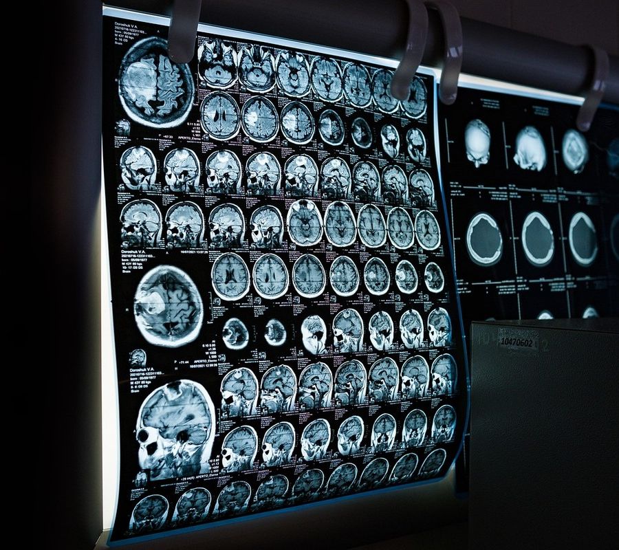 L'intelligenza artificiale, un aiuto in più per la diagnosi e il monitoraggio del Parkinson