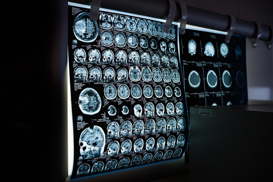 L'intelligenza artificiale, un aiuto in più per la diagnosi e il monitoraggio del Parkinson